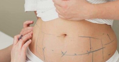 Which is better liposuction or CoolSculpting