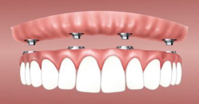 Dental Implants