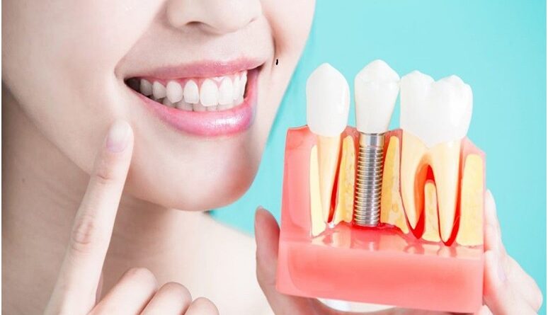 Dental Implants