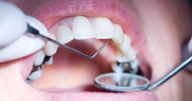 Amalgam Filling Removals: Everything You Want to Know